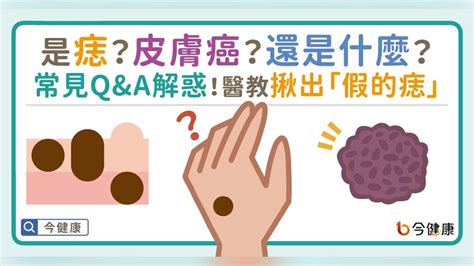 痣為什麼會凸起來|是痣？皮膚癌？還是什麼？常見Q&A解惑！醫教揪出「。